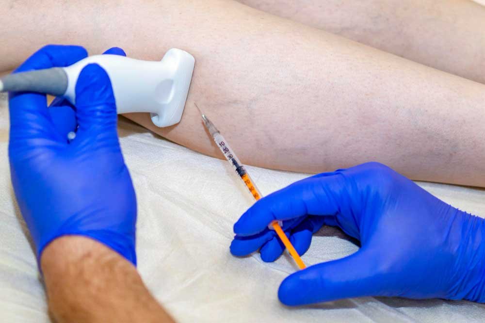 Laser vein removal