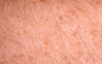 Red and Brown Spots Treatment