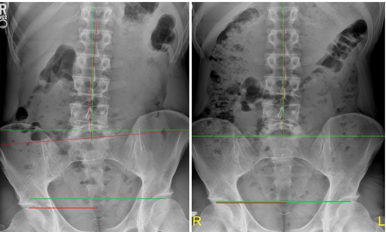 Difference in leg length pain