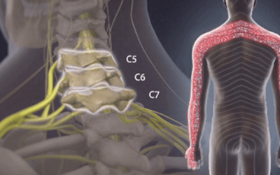 Spinal Stenosis in The Cervical Spine
