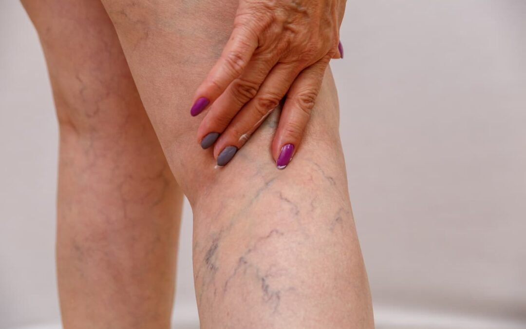 laser spider vein removal