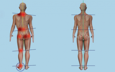 Could Your Pain be Caused by a Difference in Leg Length?