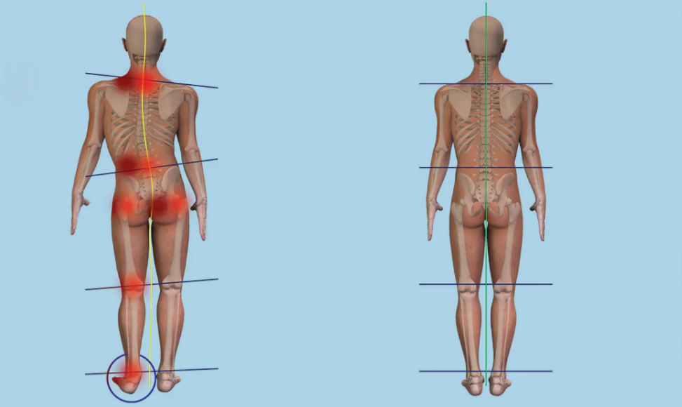 Pain caused by Leg Length difference