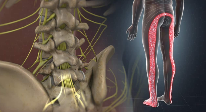 Causes of Disc Herniation