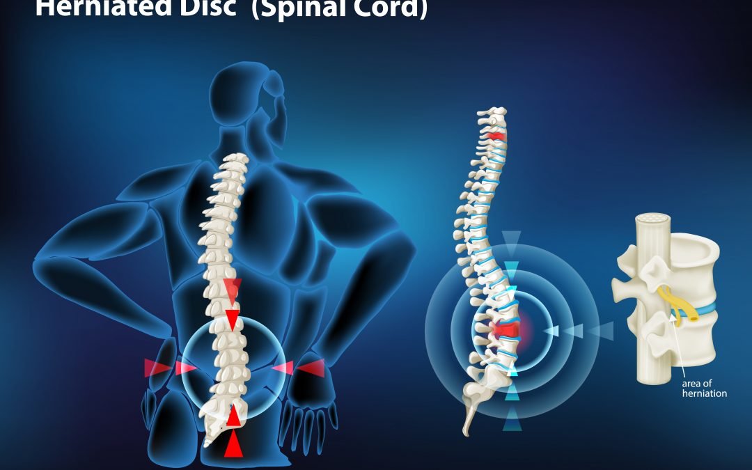 Understanding Disc Herniation Causes and Treatments