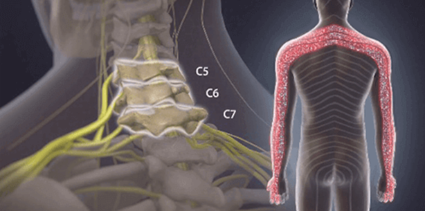 Spinal Stenosis in The Cervical Spine