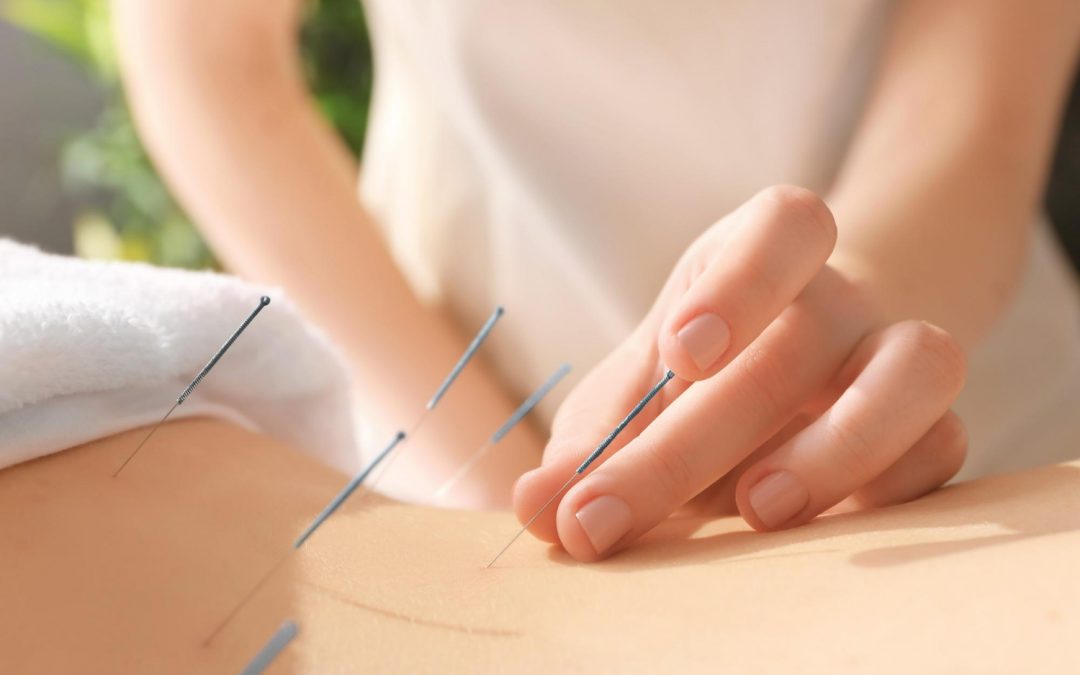 Combining Chiropractic Care and Acupuncture for Optimal Pain Relief at Noracare Wellness