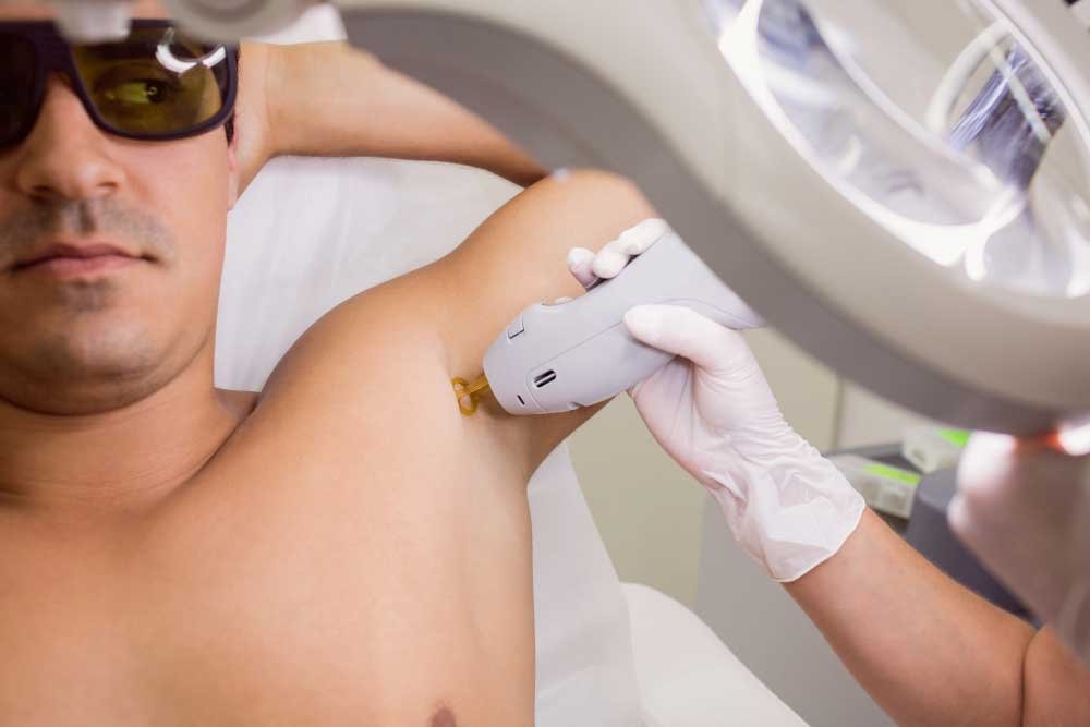 Laser Hair Removal