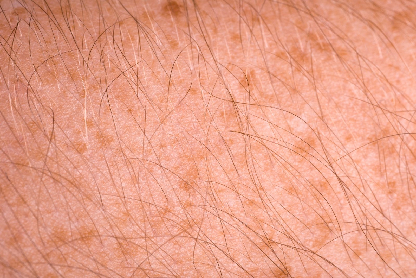 Brown Spots Treatment