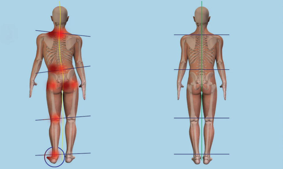 Could Your Pain be Caused by a Difference in Leg Length?